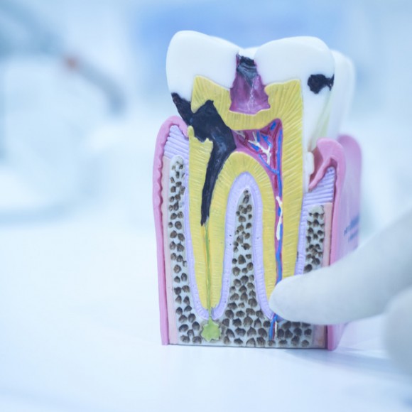 photodune-11846825-dental-tooth-model-cast-showing-decay-enamel-roots-s-580x580