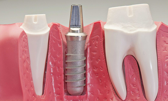 Implantologia studio dentistico massella verona