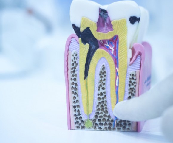 photodune-11846825-dental-tooth-model-cast-showing-decay-enamel-roots-s-580x580